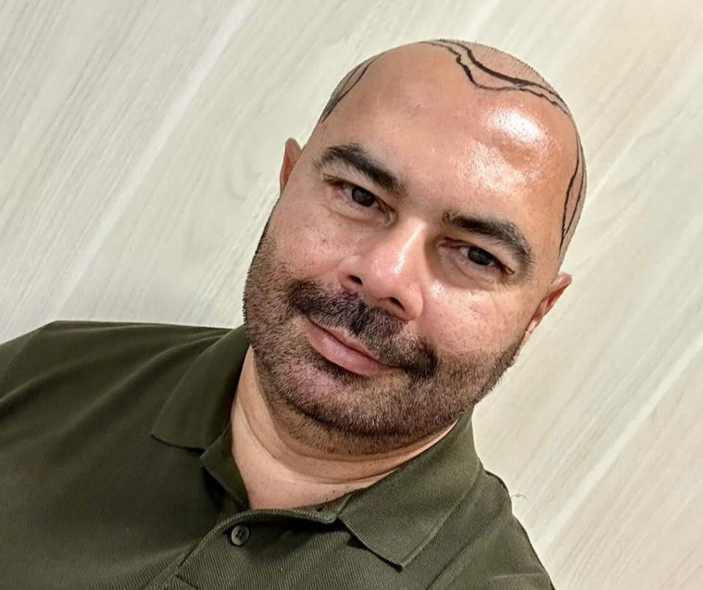 Idilvan Alencar aparece careca nas redes sociais e diz ter feito implante capilar